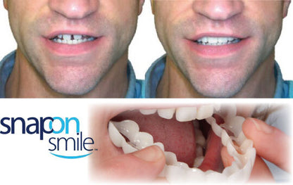 Carillas Snap On Smile®