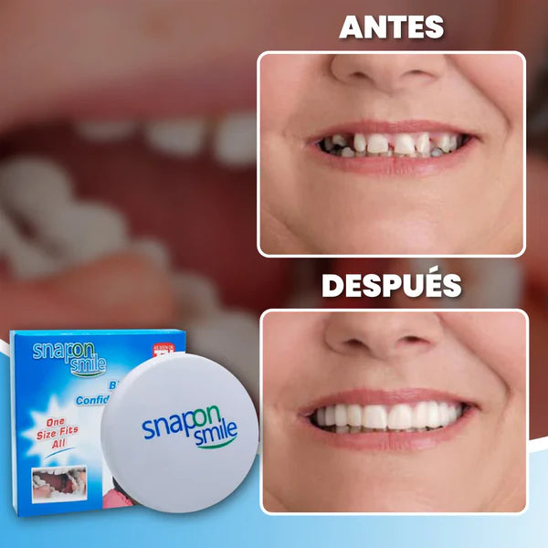 Carillas Snap On Smile®